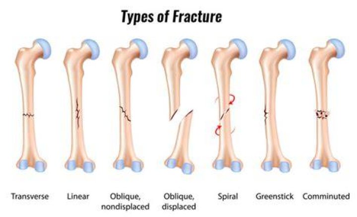What is a subacute fracture?