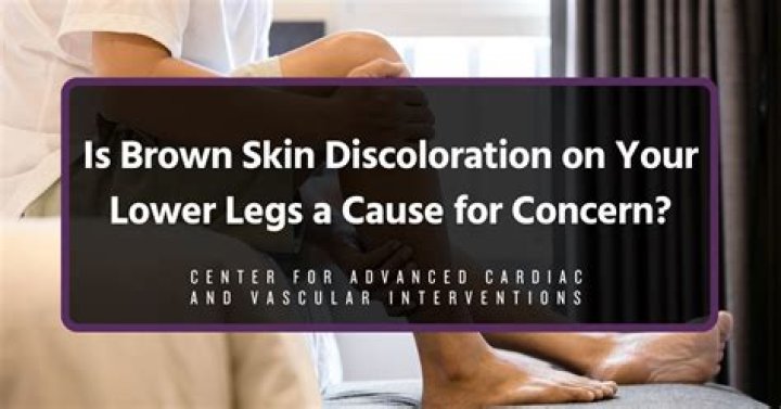 What is brown discoloration on legs?