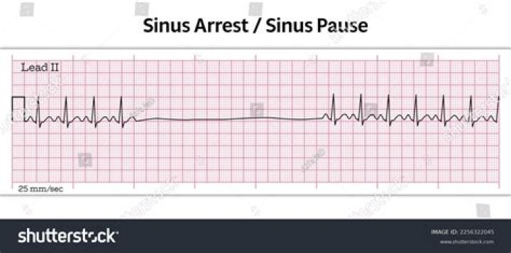 What is caesural pause definition?