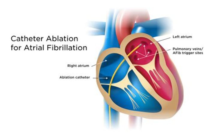 What is epicardial ablation?