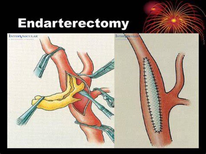 What is meant by endarterectomy?