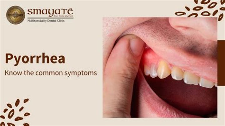 What is meant by pyorrhea?