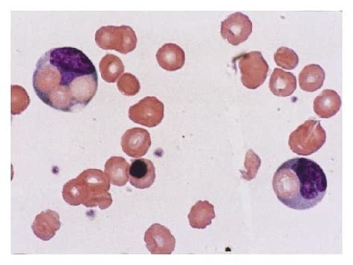 What is paroxysmal cold hemoglobinuria?