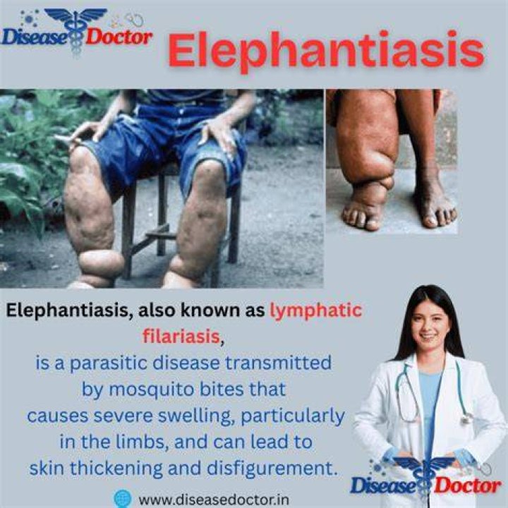 What is the main cause of elephantiasis?