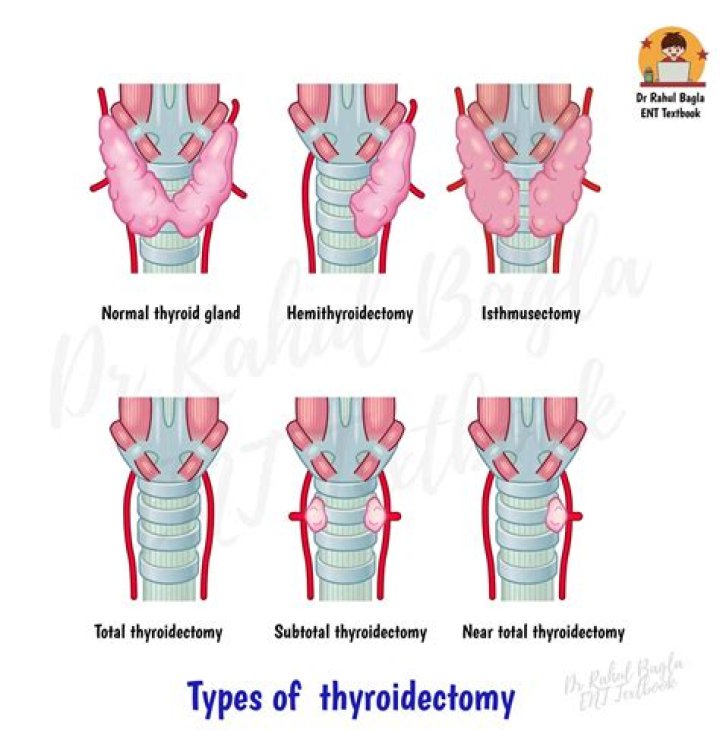 What is thyroidectomy mean?