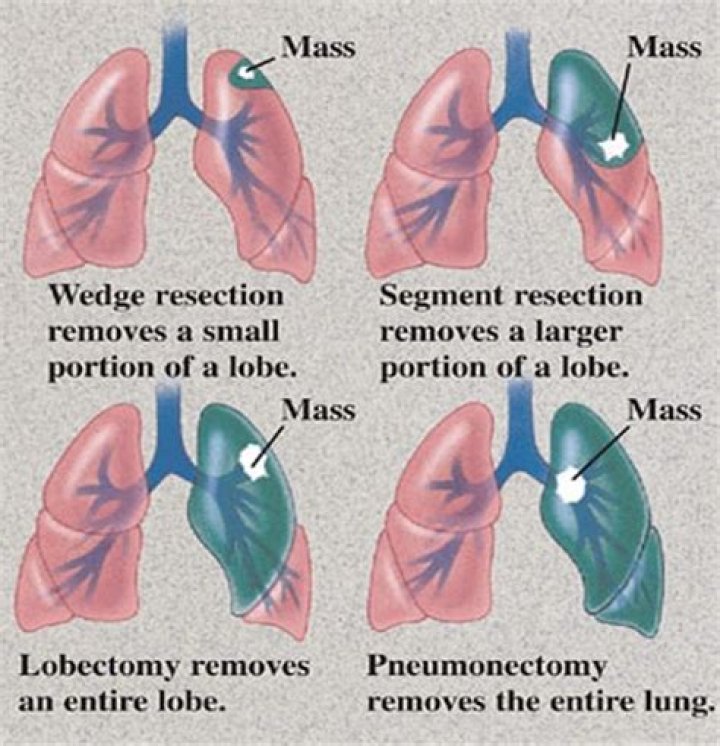 When is a lobectomy performed?