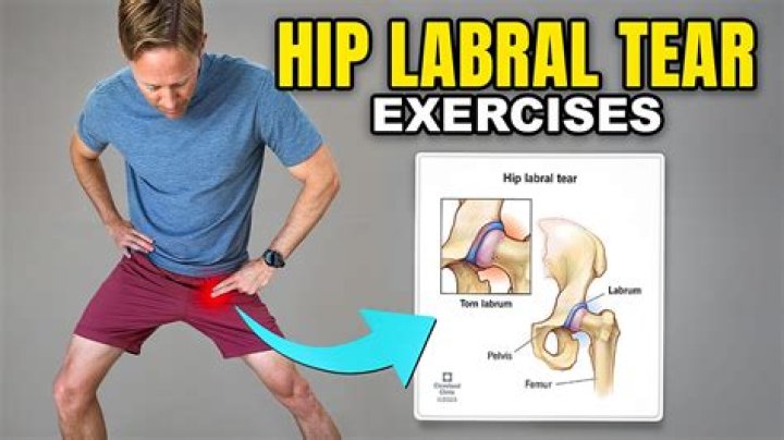 When to have labrum surgery?