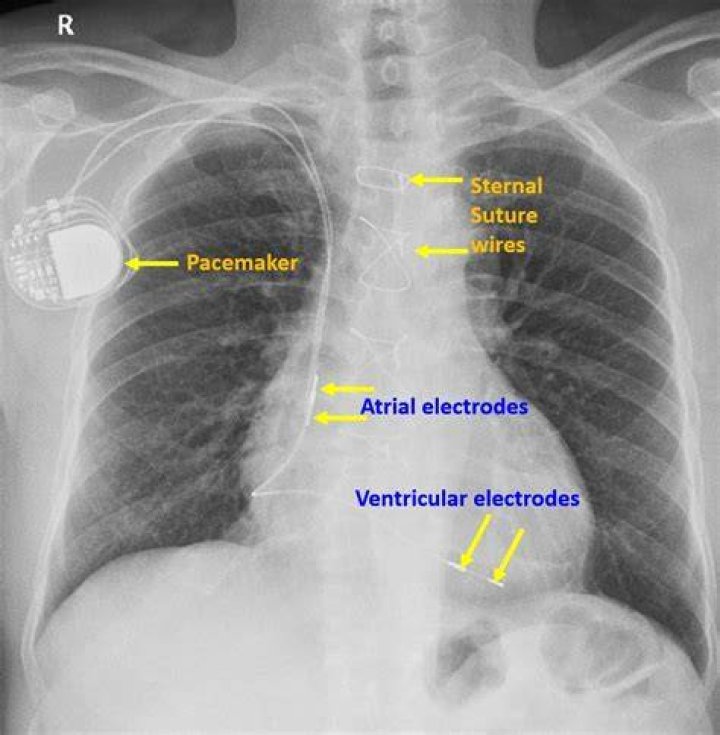 Where are epicardial pacing wires placed?