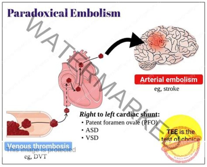 Where did paradoxical embolism originate?