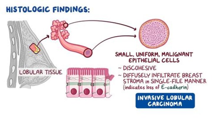 Where does invasive lobular carcinoma metastasis?