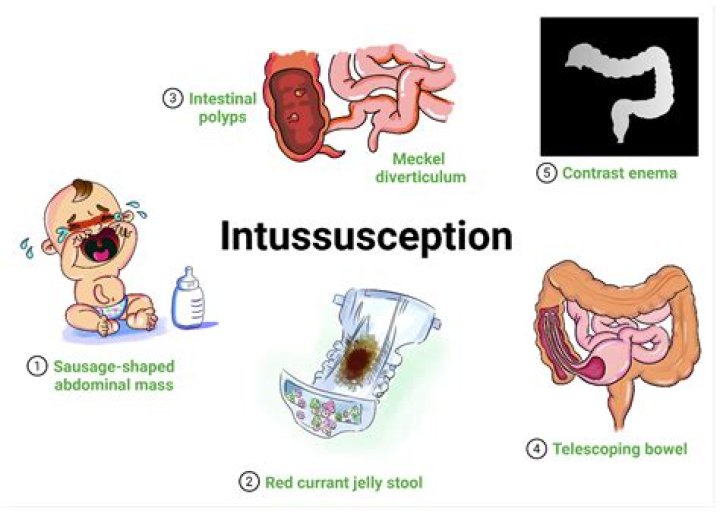 Where is intussusception located?