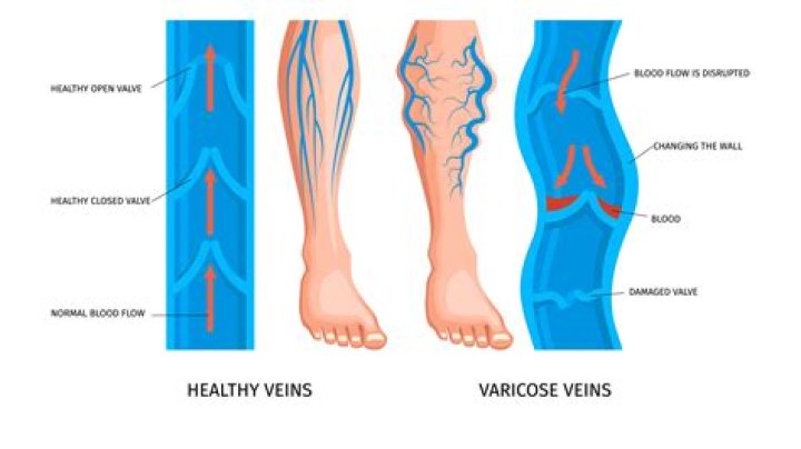 Where is venous admixture?
