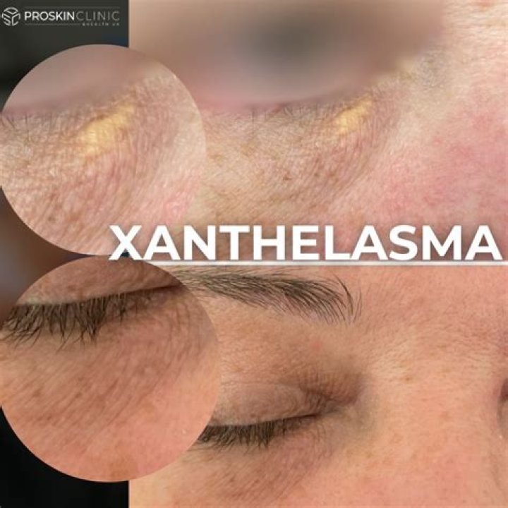 Which doctor to consult for xanthelasma?