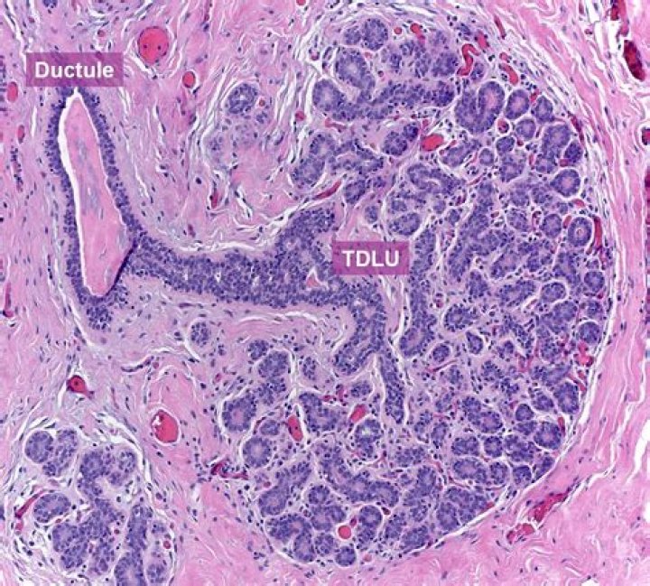 Which is worse lobular or ductal cancer?