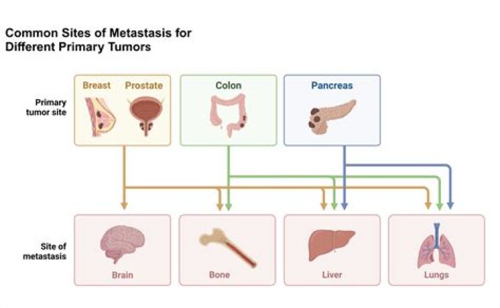 Which malignancy metastasis to heart?