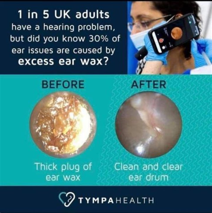 Who can take earwax out?