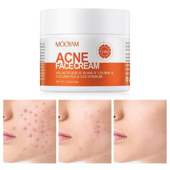 Who is the best cream for pimples?