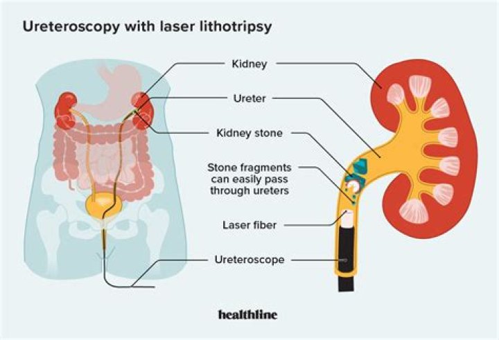 Why bowel prep before lithotripsy?