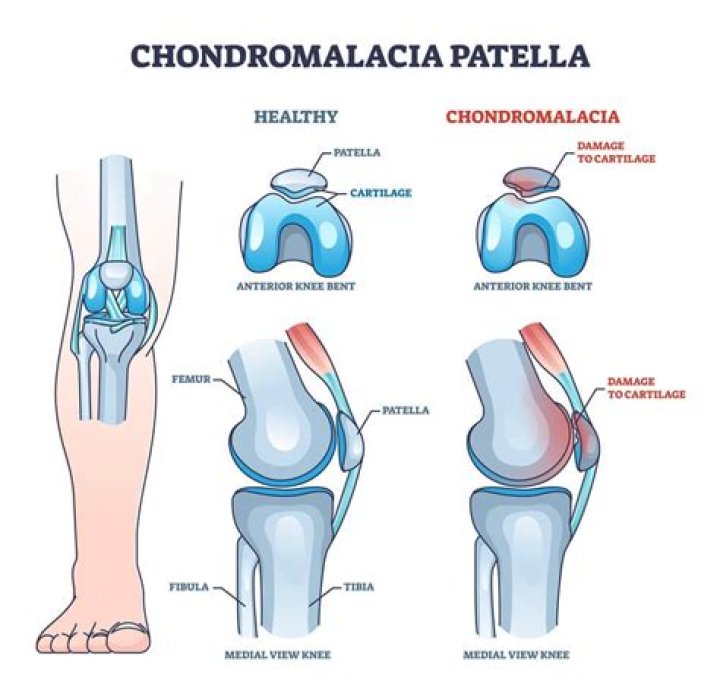 Why does chondromalacia occur?