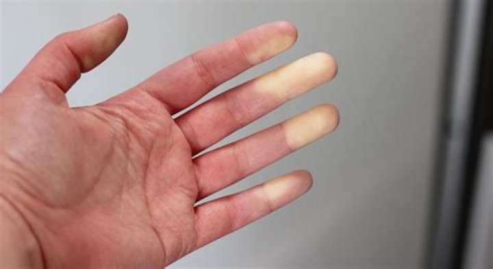 Why fingers go white when cold?