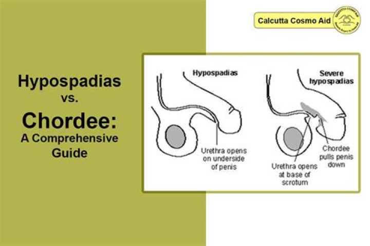 Why is circumcision contraindicated in hypospadias?