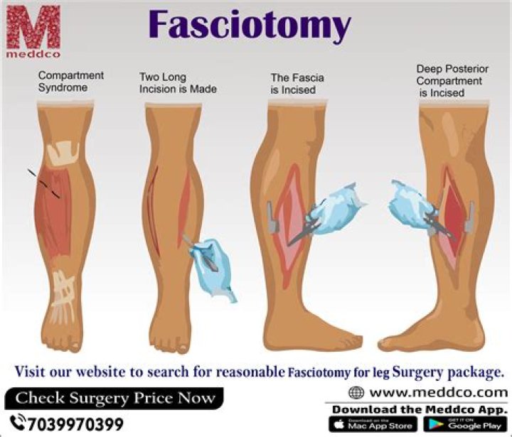 Why would you need a fasciotomy?