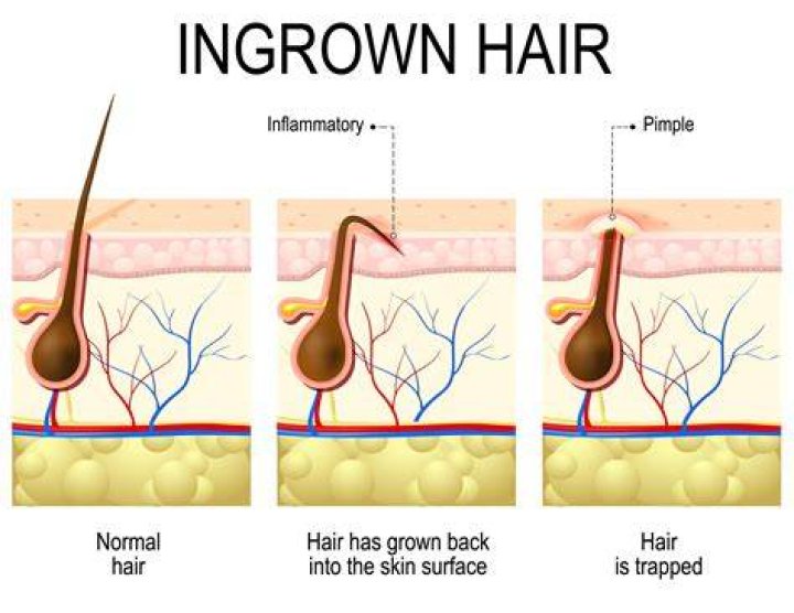 Will an ingrown hair sort itself out?