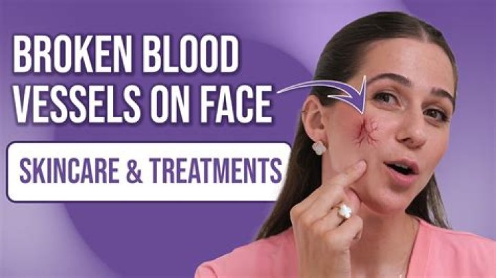 Will broken blood vessels on face go away?