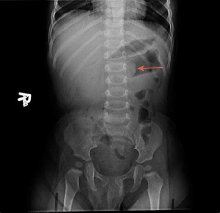 Will intussusception show on x ray?