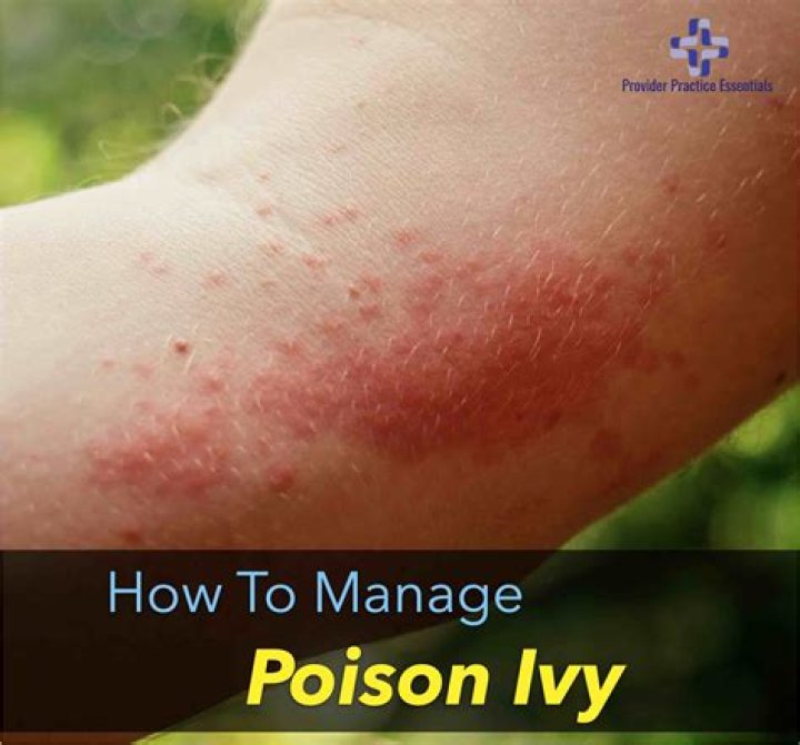 Will weeping poison ivy spread?