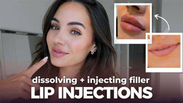 Would lip injections look good on me?