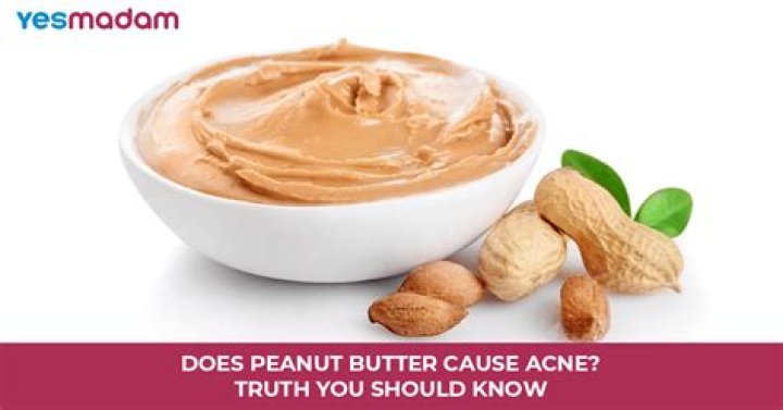 Would peanut butter cause acne?